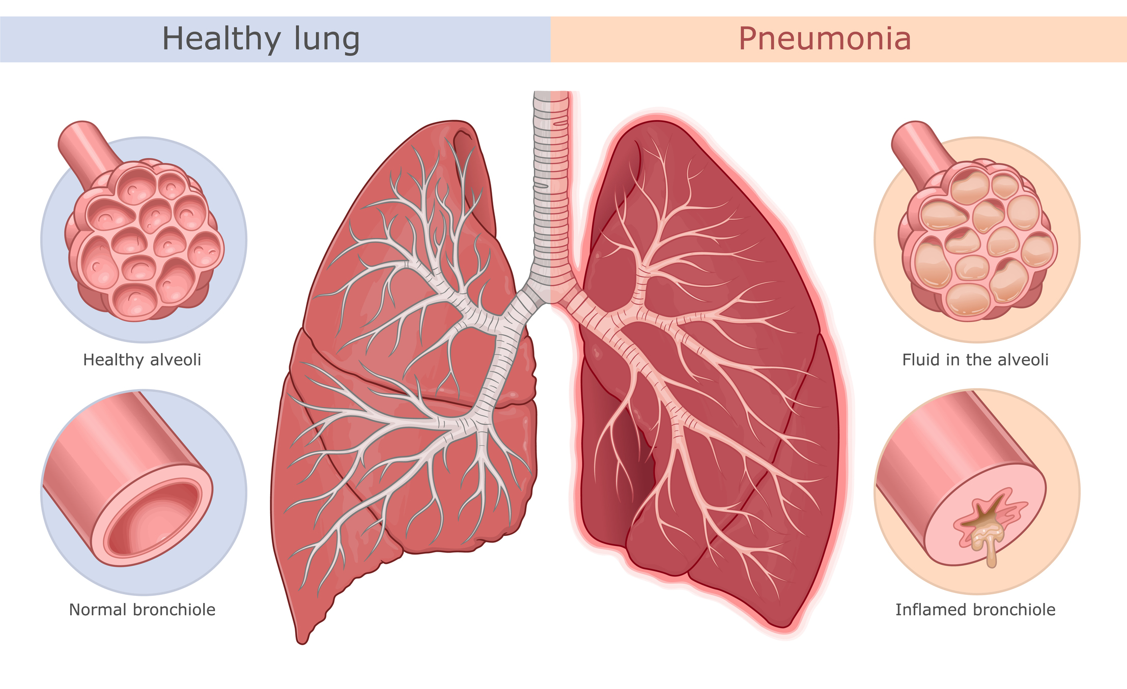 What is Pneumonia? | NYSenate.gov